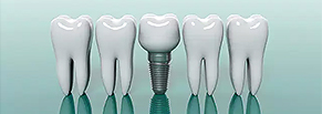 Продвижение стоматологической клиники имплантации зубов в Москве